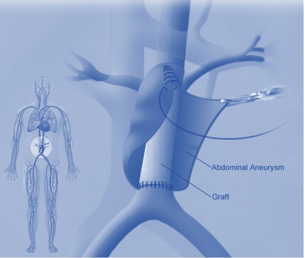 Abdominal Aortic Aneurysm (AAA) - Market Outlook 2030