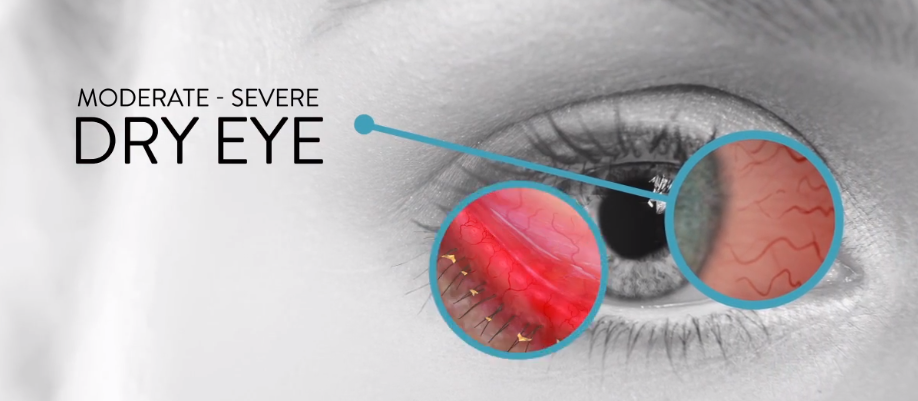 Dry Eye Disease (DED) - Market Outlook 2030