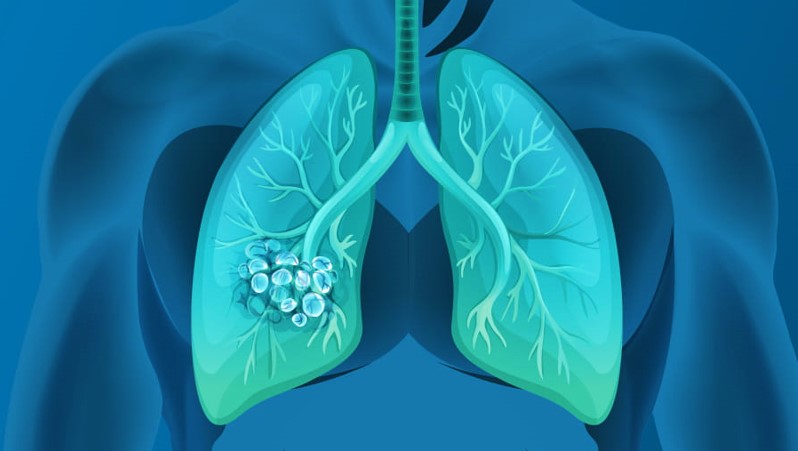 Non-Small Cell Lung Cancer (NSCLC) - Market Outlook 2030